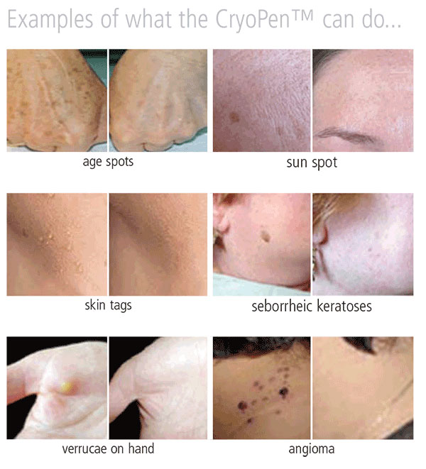 What CryoPen can do for you with SKiN Private Aesthetic Clinic