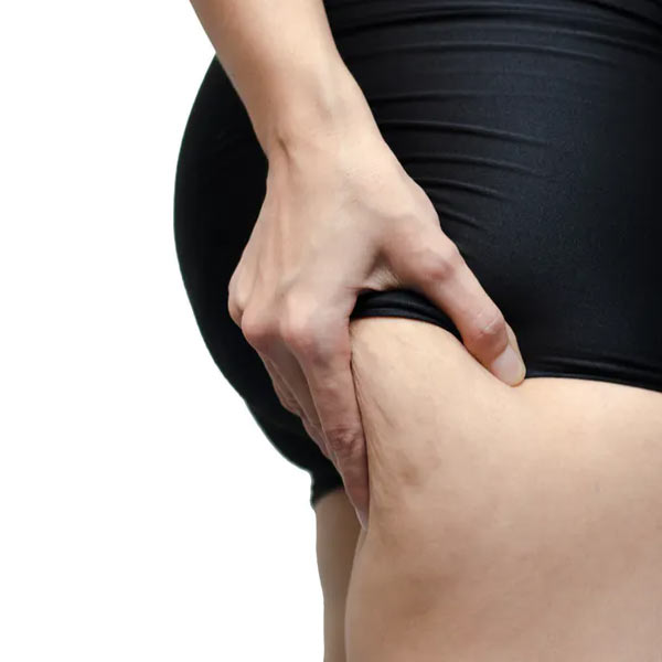 cellulite treatment